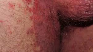 Both types of herpes simplex virus produce 2 kinds of infections: Psoriasis Vs Herpes What S The Difference