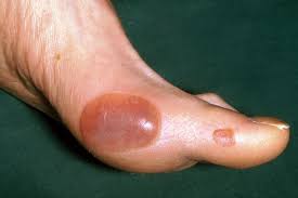 A tingly feeling like pins and needles could a number of people with diabetes report intense pain when the skin on their feet or legs come into if your feet are numb, and not just temporarily, it could be a sign of diabetic neuropathy which is nerve. Pictures Of Skin Problems Linked To Diabetes