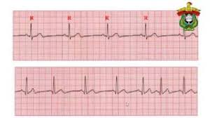 Check spelling or type a new query. Latihan Interpretasi Ekg Dasar Syahrul Ningrat Youtube
