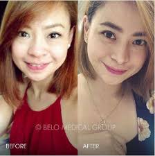 People Who Got Plastic Surgery In Their 20s