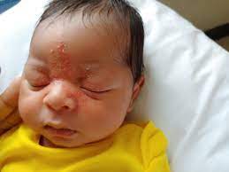 Home skin conditions & beauty centertopic guide what is skin rash? Newborn S Rash Involves Eyes And Nose