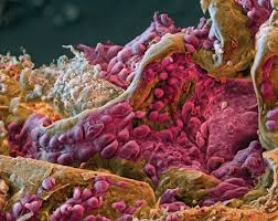 Because of where these tumors grow,. Research Round Up Lung Cancer