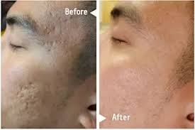 ليزر ثاني أكسيد الكربون الجزئي قبل وبعد النتائج