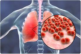 Image result for Pneumonia