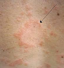 Called a herald patch, this spot can be up to 4 inches (10 centimeters) across. Pityriasis Rosea Wikipedia