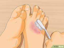 How To Get Rid Of Bruises Fast 11 Steps With Pictures Wikihow