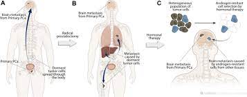 Bone metastasis can be painful and can cause other problems, such as fractures (breaks), spinal cord compression (an area of cancer is pressing on the spinal cord), or high blood calcium levels, which can be dangerous or even life threatening. Impact Of Therapeutic Management On Prostate Cancer Brain Metastasis Download Scientific Diagram