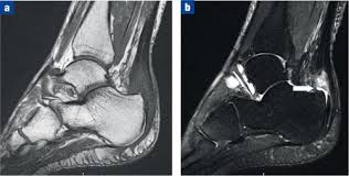 Haglund syndrome, haglund^s deformity, achilles tendon tenopathy, conservative radiology. Imaging The Patient With Heel Pain British Journal Of Hospital Medicine