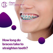 You might also need an interproximal reduction which removes teeth enamel to ensure you have enough space. Facebook