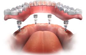 Image result for dentures