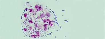 Image result for Group B Streptococcus