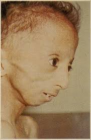 Image result for Micrognathia