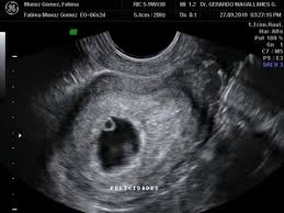 Cuando una mujer descubre que está embarazada, son muchos los cambios que tiene que hacer en su estilo de vida para no comprometer la salud del bebé ni la suya. 6 Semanas De Embarazo Club De Bebes Enero 2020 Los Primeros Pequenos De Un Nuevo Decenio Babycenter