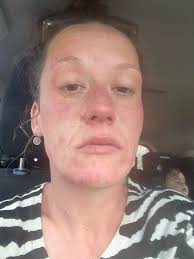 I have these white splotches all over my body. Its not vitiligo. Starting  ten years ago when I would eat sweet things these splotches would show up 