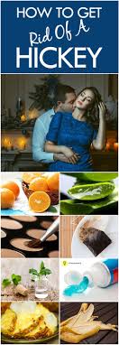 How To Get Rid Of A Hickey Hickeys Rid How To Hide Hickeys