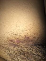 More importantly, pubic hair serves as protection against bacteria and other pathogens. those areas have been proven to trap huge amounts of bacteria. I Have Extreme Ingrown Hairs On My Pubic Area Would Laser Treatment Be Best Photos