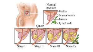 To quote wikipedia, a symptom is a departure from normal function or feeling which is noticed by a patient, reflecting the presence of an unusual state, or of a disease. in this case prostate cancer. Prostate Cancer Treatment Hospitals Urologists And Oncologists Near Me