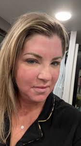 Day 2- Looking a little scary today 😜 Woke up pretty swollen but that is a  good response. It’s also very tight and getting pretty itchy but the  redness is better. Follow along for the day to day ...