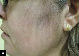 However, the hair will grow back once use of the medication is discontinued. Racgp Facial Hair Growth In A Patient With Psoriasis