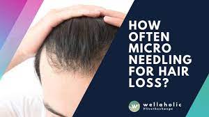 Shedding is often misinterpreted as permanent loss, and it can cause a lot of people to make wild every single summer season i would have a brutal shed and it was literally the life cycle of my hair that's a perfect example of shedding which is temporary loss. How Often Microneedling For Hair Loss