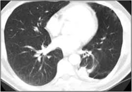 They are not dangerous and in nearly all cases, . Imaging Of Asbestos Related Lung And Pleural Diseases As An Endemic Exposure In Egypt Egyptian Journal Of Radiology And Nuclear Medicine Full Text