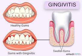 gingivitis treatment and home remes