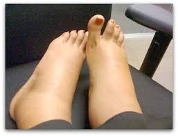 Meskipun kaki bengkak saat hamil masih dianggap normal. Cara Mengatasi Kaki Bengkak Pada Ibu Hamil Kompasiana Com