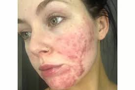 Teacher with severe acne tells how social media trolls…