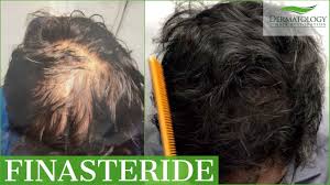 This procedure is basically a matter of injecting the right chemicals into as stated already, hair loss is not too good for your self confidence. Topical Finasteride Incredible Results For Male Hair Loss Dr Ben Behnam Los Angeles Youtube