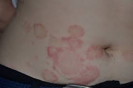 Most of the studies in the treatment of. Dermatomicozele Dermatologie Brasov