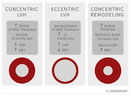 When doctors talk about remodeling, they are usually talking about the left ventricle, though occasionally this term is applied to other cardiac chambers. Understanding Lvh Part 1 Concentric Eccentric And Concentric Remodeling