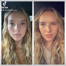 Thank you botox 💉