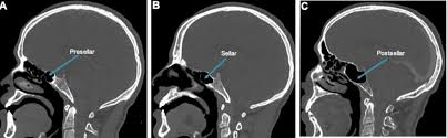 Image result for Sinus CT