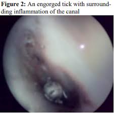 He ticked off those he had just interviewed and wondered which of the rest ought to take up his time and attention.• The Many Faces Of Intra Aural Tick Clinical Presentation Jpms