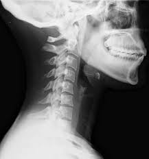 Pain management is key to a successful recovery after surgery. Whiplash Medicine Wikipedia