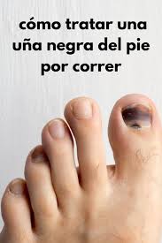 Maybe you would like to learn more about one of these? Como Tratar Una Una Negra Del Pie Por Correr Decorredores