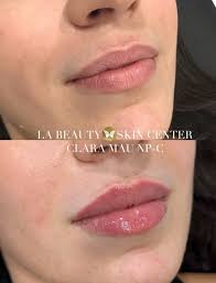 Before & After Lip Filler 👄💉• Performed by Clara! Call Us To Schedule An  Appointment! 📞 818.888.0001 📍 North Hollywood #explore #trending  #labeautyskincenter #medspa #beforeandafter #lipfiller #filler #lips  #aesthetic #aestheticinjector #injector ...
