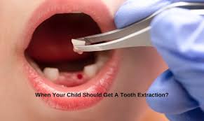 Image result for Tooth Extraction