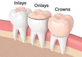 What S A Dental Inlay Dental Restoration Dental Hygiene Student Dental Hygiene School