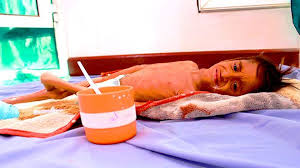 أجساد هزيلة في مستشفى يمني شاهدة على 6 سنوات من الدمار تجهد الرضيعة مسيرة صقر الخويري
