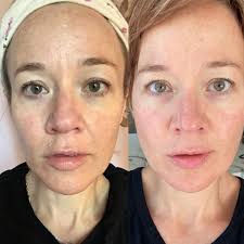 Using Original Skin Repair for Wind Burn in Ashland, WI