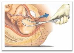 Image result for Forceps Assisted Delivery