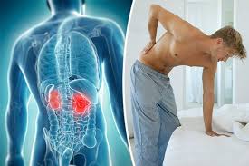 Kidney cancer is cancer that begins in the kidneys. Kidney Cancer Symptoms 12 Early Warning Signs You Should Never Ignore Daily Star
