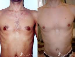 Sugaring is a method where a sticky ball of sugar, lemon juice, water and a binding agents are used to remove the hair. Vermont Laser Services Burlington Vermont Laser Hair Removal Vermont Laser Services