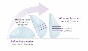 In australia implants used in breast augmentation can be made of either silicone gel or saline (a salt and water mixture). Motiva Breast Implants Perth Wa Dr Robert Goldman