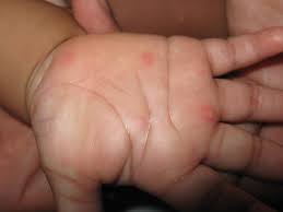 Il provoque des ampoules (boutons rouges) sur les mains et les pieds, dans la bouche. Syndrome Pieds Mains Bouche Et Son Traitement Devenir Grand