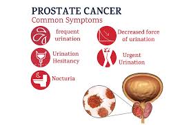 Prostate cancer, the second most common cancer for men, impacts one out of six men. 50 Men To Benefit From Free Prostate Screening Guyana Chronicle