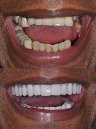 Here are some average costs of these dental procedures with and without insurance, as reported by costhelper. The Cost Of Dental Work In Cali Colombia Dental Tourism Colombia Dental Tourism Colombia