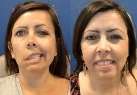 Bell's palsy is temporary weakness or lack of movement affecting 1 side of the face. What You Should Know About Bell S Palsy Mayfair Wellness Clinic