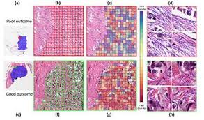All breast cancers are often missing a chromosome fragment known as 17p, which contains genes that can help the body suppress cancerous tumors. Artificial Intelligence Aids In Discovery Of New Prognostic Biomarkers For Breast Cancer Imaging Technology News